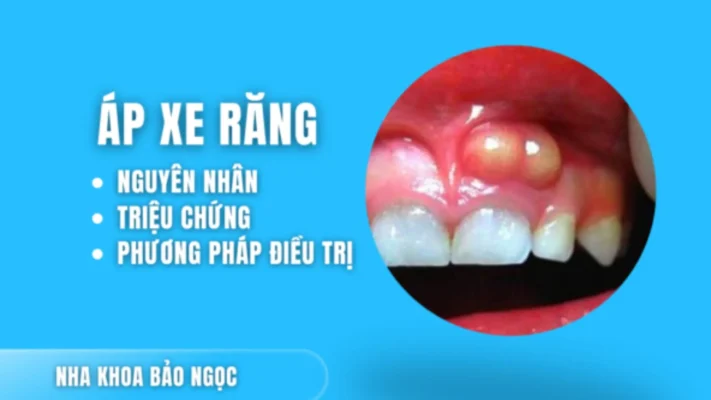 Áp xe răng là gì? Nguyên nhân và phương pháp điều trị