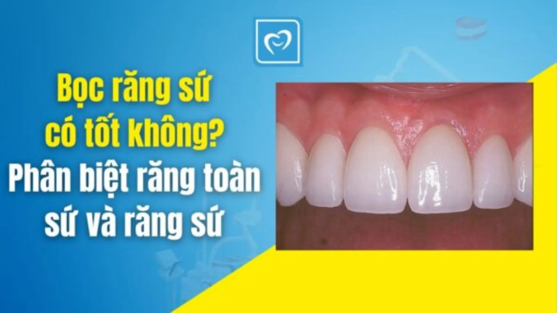 Bọc răng sứ có tốt không? Răng toàn sứ khác răng sứ như thế nào?