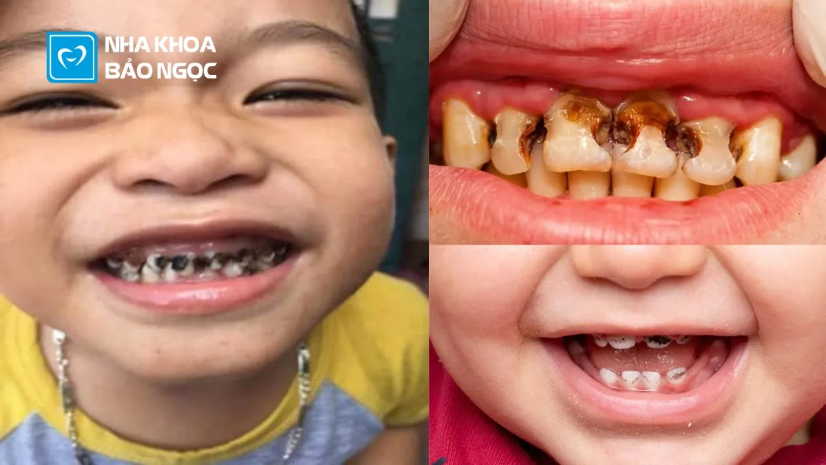 Phương pháp ngăn ngừa sâu răng mà các bậc phụ huynh cần biết
