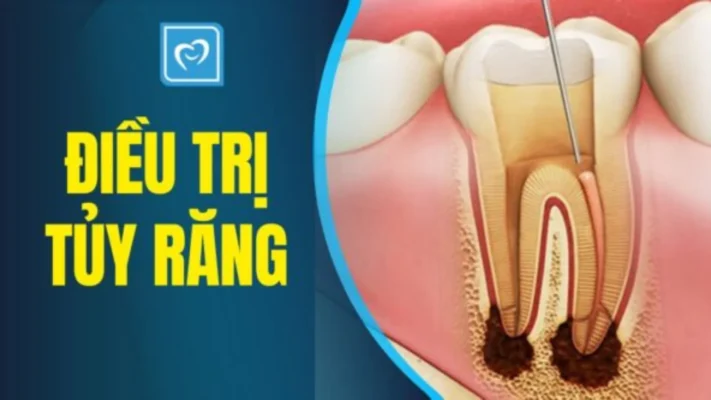 Điều trị tủy răng: trường hợp nào thì cần điều trị tủy