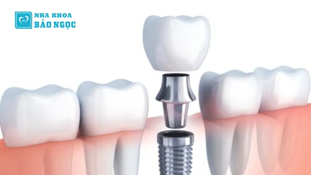 Lành vết thương trồng răng Implant bao lâu