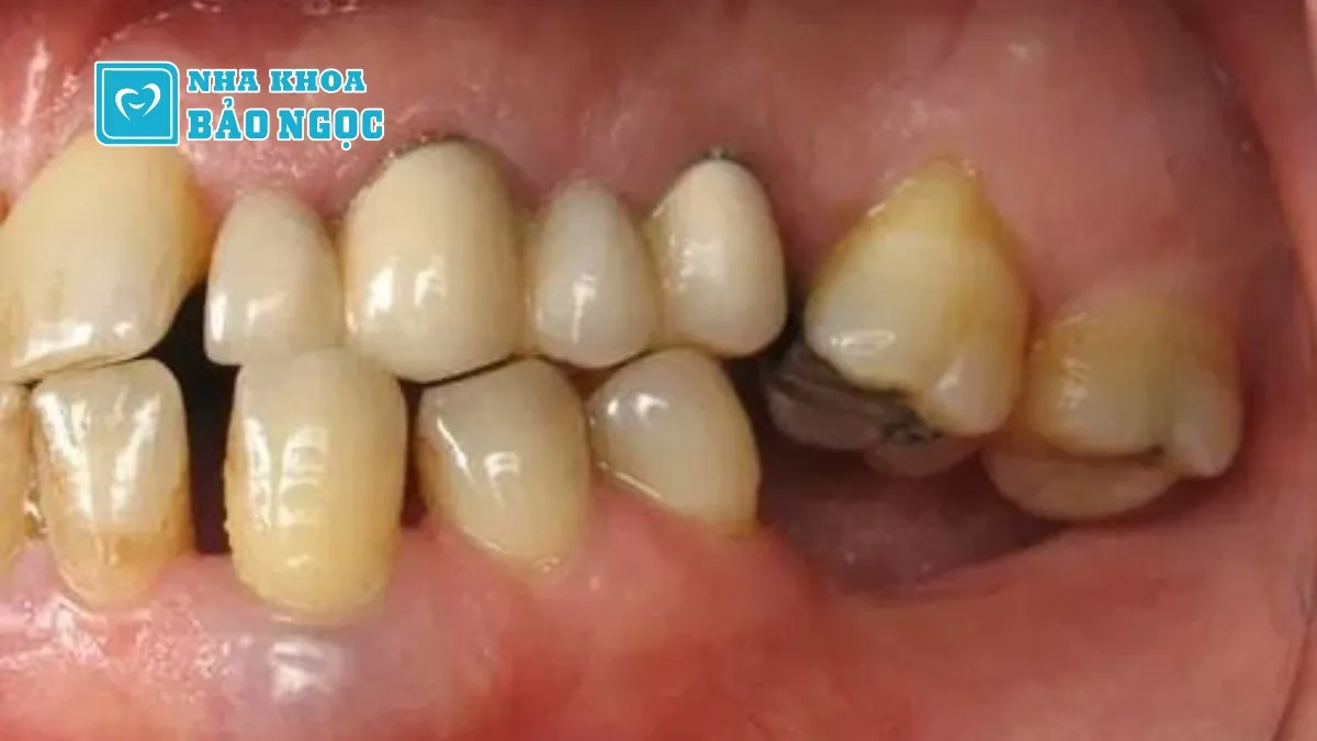 Hậu quả của mất răng, mất răng lâu năm có trồng được không?