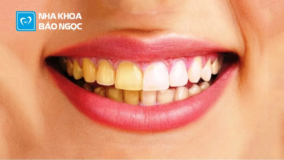 Phương pháp làm trắng răng phổ biến 