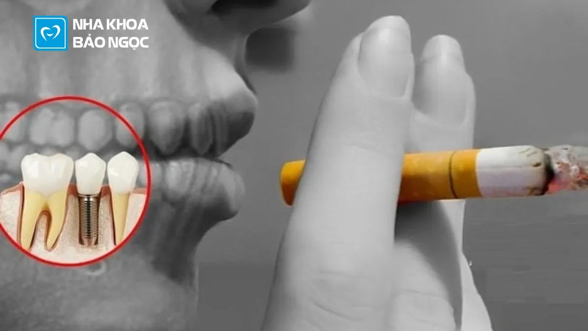 Răng implant bị đào thải và cách khắc phục