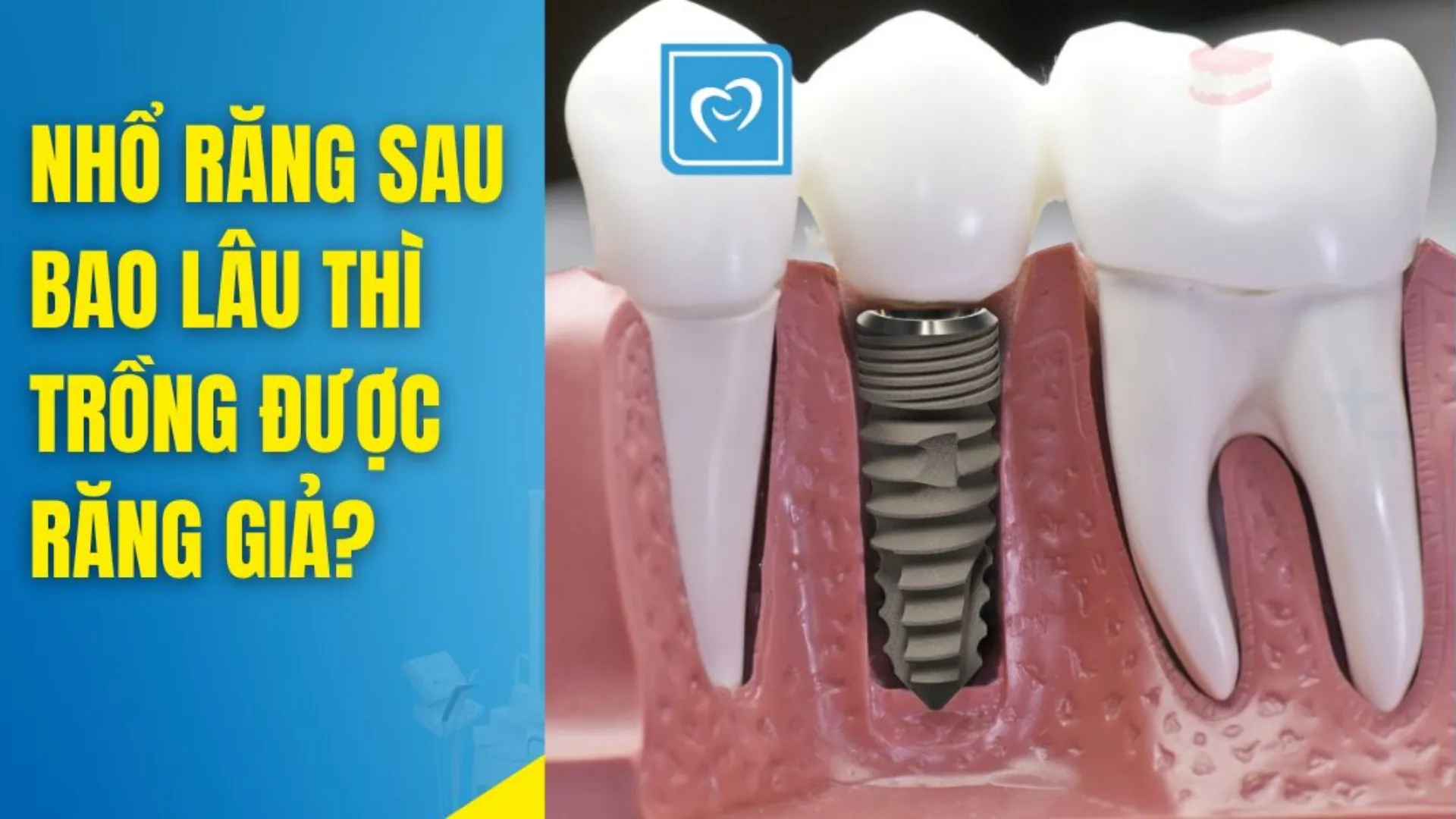 Trồng răng giả sau bao lâu kể từ khi nhổ răng?