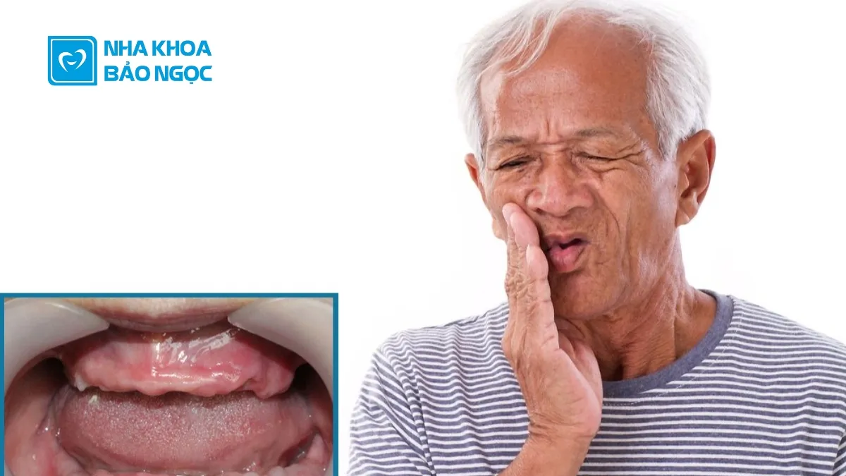 Mất răng toàn hàm, nửa hàm thì phải làm sao?