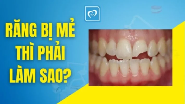 Răng bị mẻ phải làm sao?