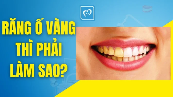 Phương pháp điều trị răng bị ố vàng, nhiễm sắc tố