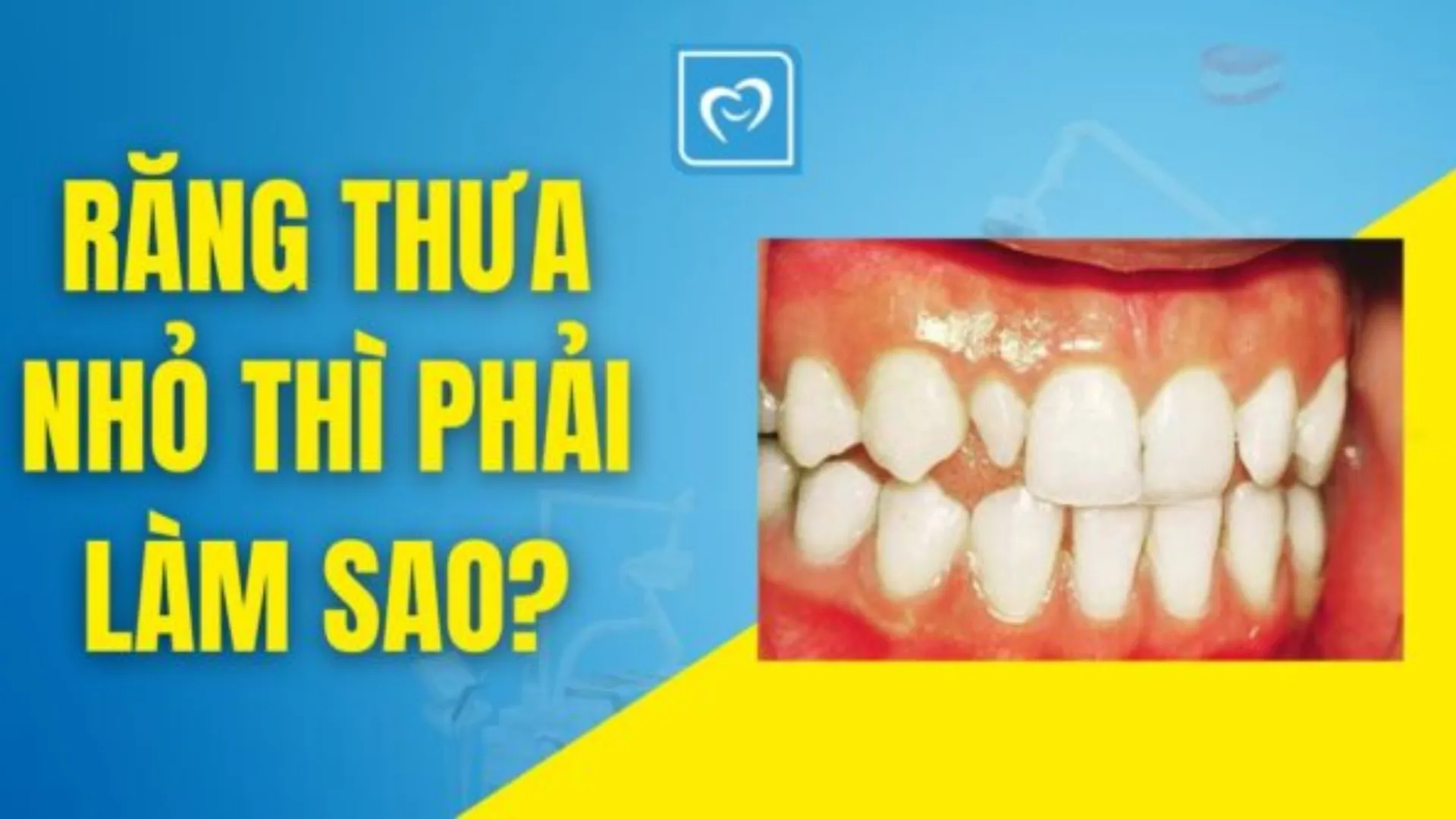 Răng thưa nhỏ thì phải làm sao?