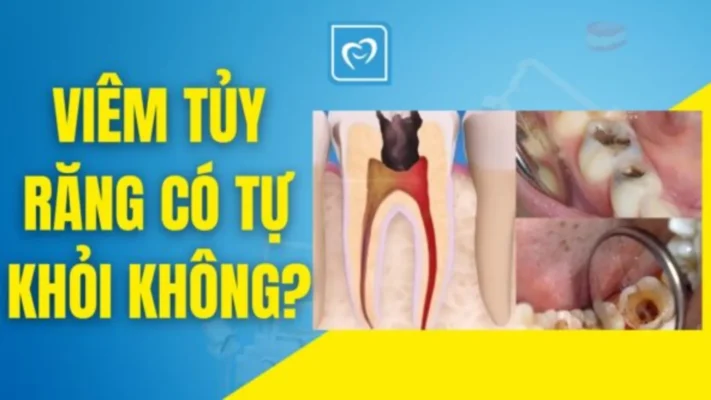 Viêm tủy răng có tự khỏi không?