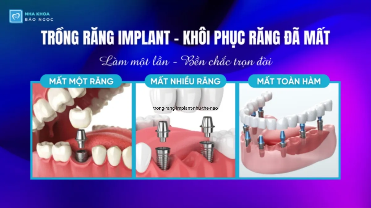 Trồng răng implant như thế nào?