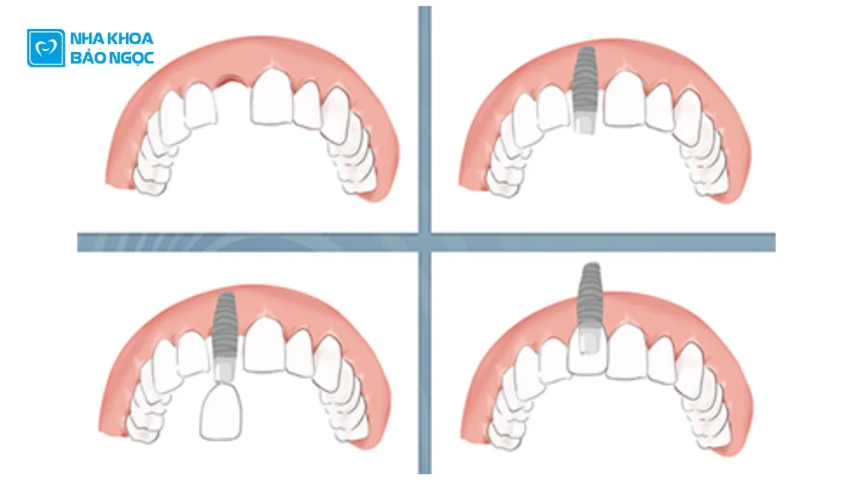Trồng răng implant như thế nào?
