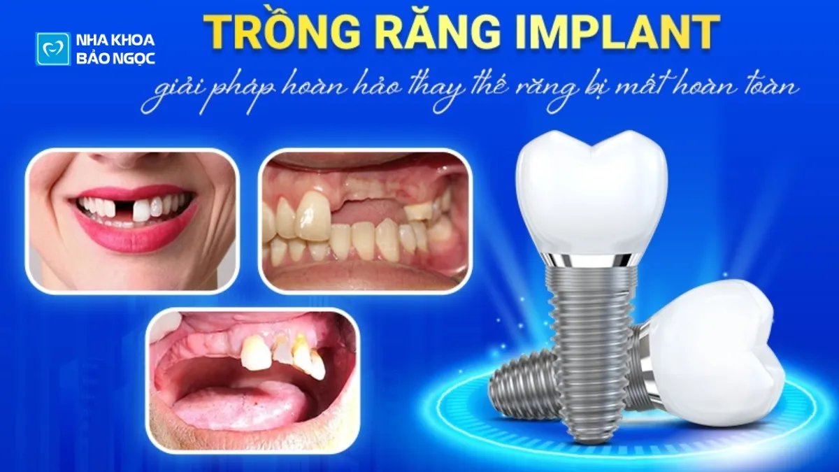 Điều kiện để cấy ghép implant?
