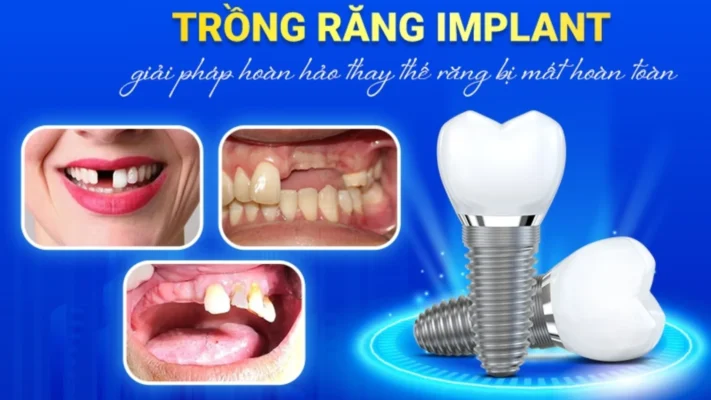 Trồng răng Implant tiết kiệm dành cho người mất nhiều răng?