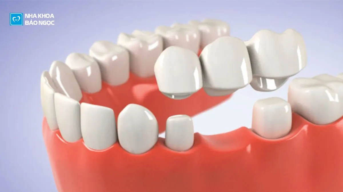 Mất răng nên chọn cấy implant hay làm cầu răng sứ?