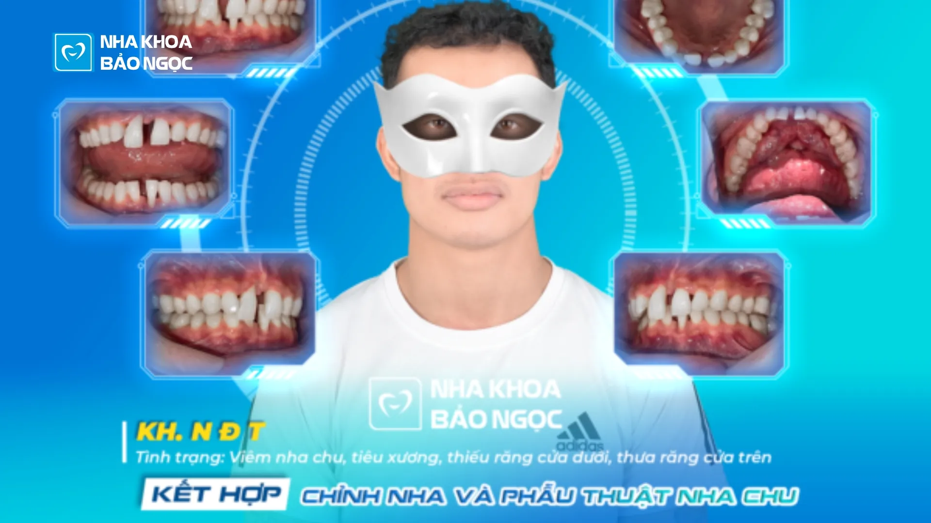 Niềng răng khoẻ đẹp cùng Đ.T 27 tuổi