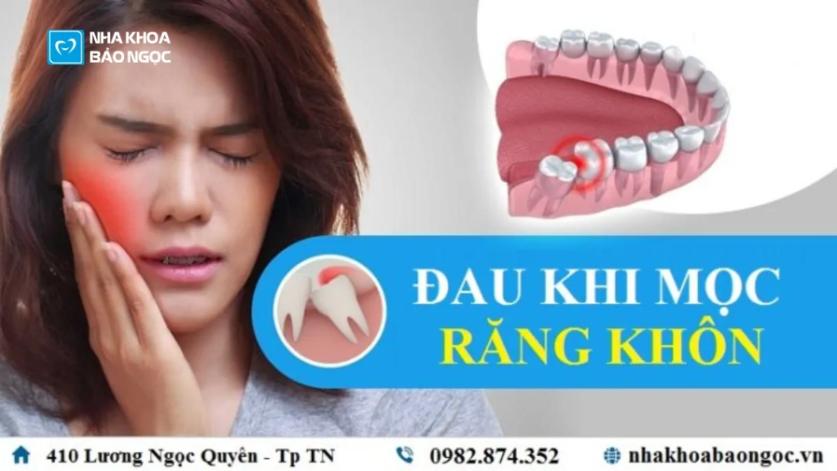 Răng khôn là gì - những điều cần biết về răng khôn?