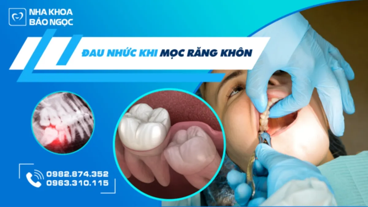 Răng khôn là gì - những điều cần biết về răng khôn?