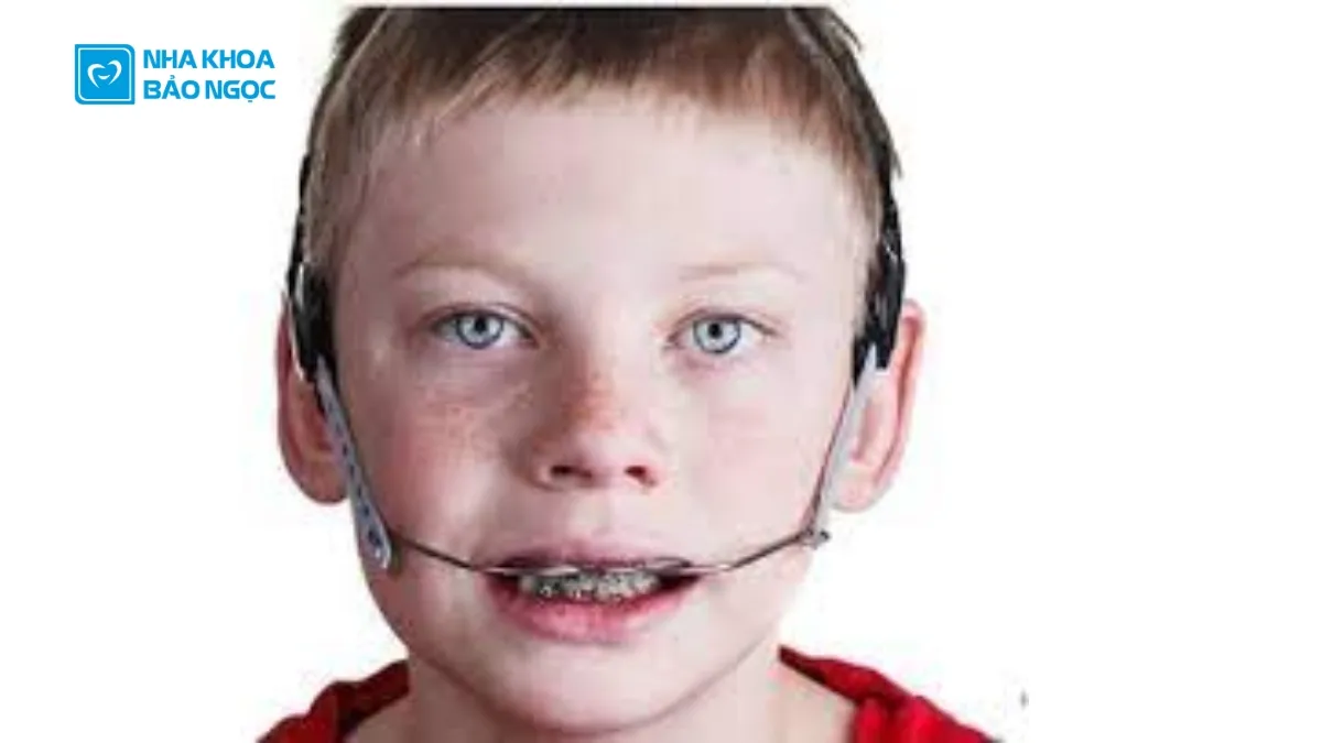 Các loại khí cụ chỉnh nha cho trẻ