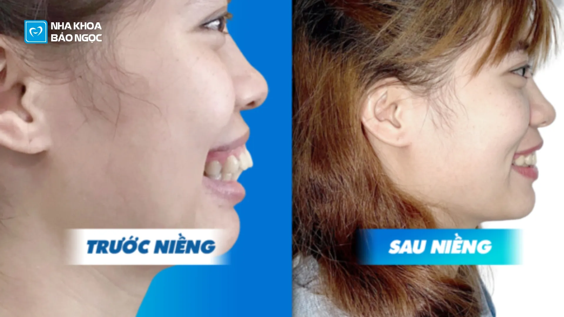 Hành trình niềng răng hô đầy thách thức và thành công của M.L 25 tuổi