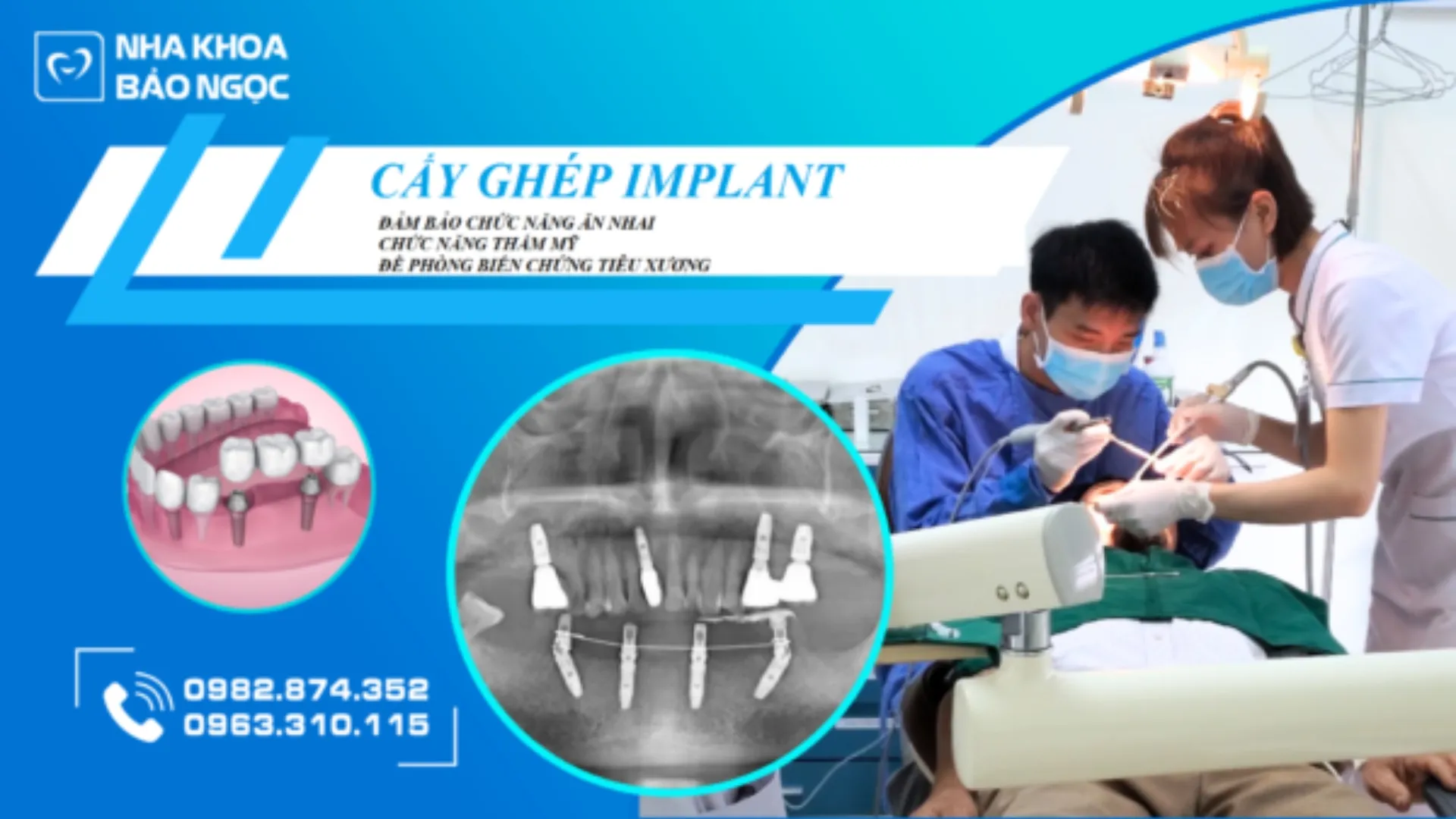Cấy ghép implant dành cho người mất răng