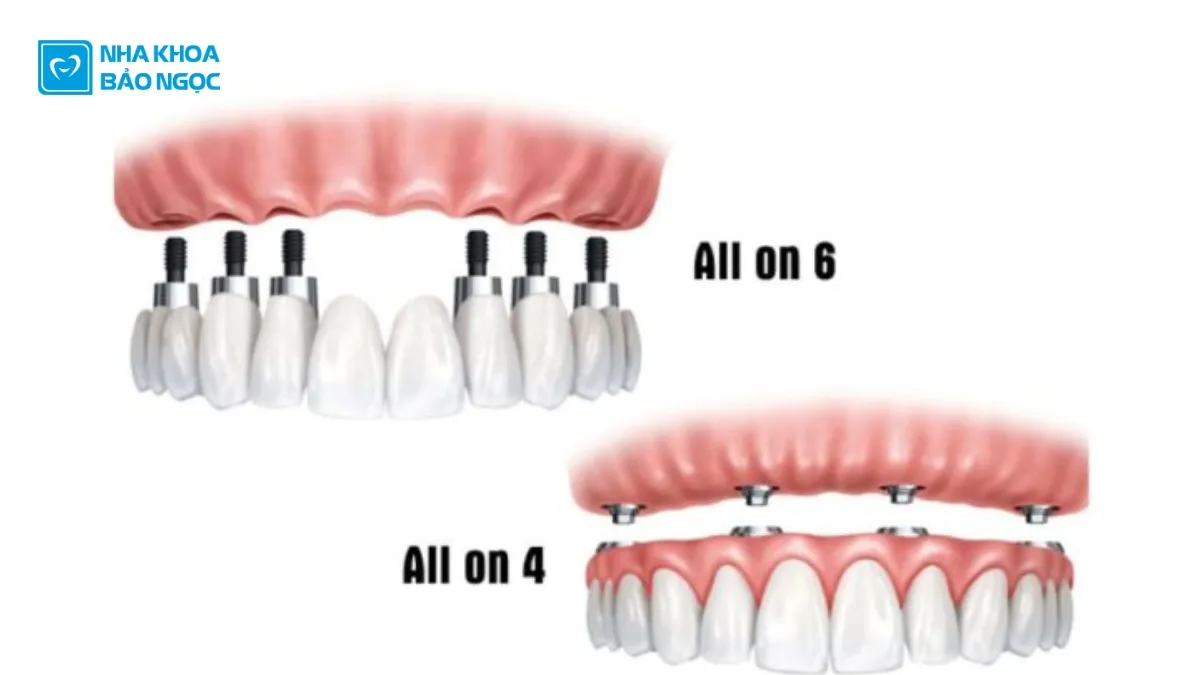 Implant nha khoa là gì?