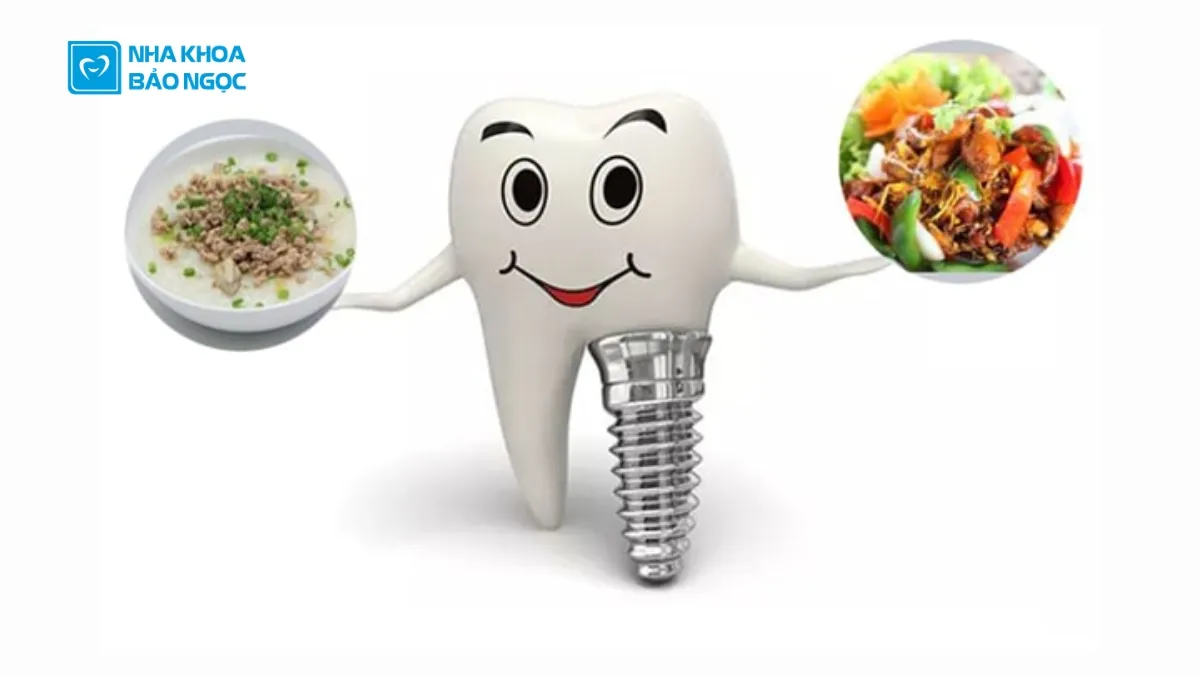 9 lưu ý sau khi trồng răng Implant nhất định bạn phải biết