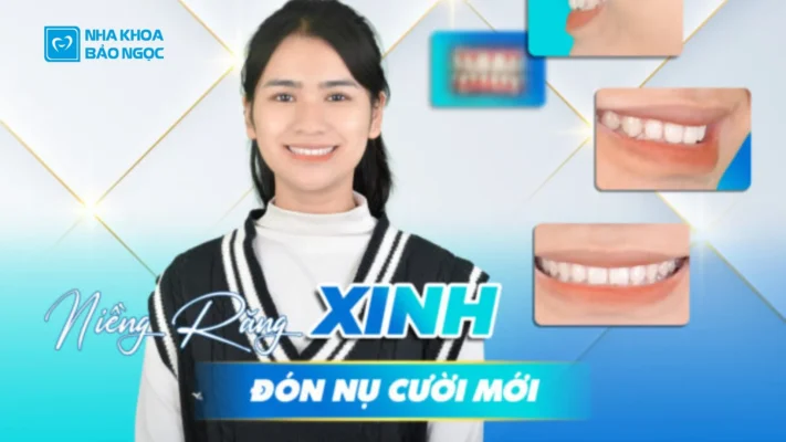 Niềng răng thành công cùng Bích Lệ 2003