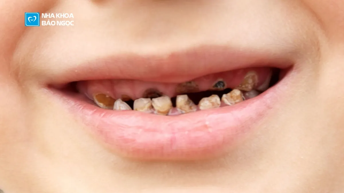 Răng sữa: những điều cha mẹ cần biết
