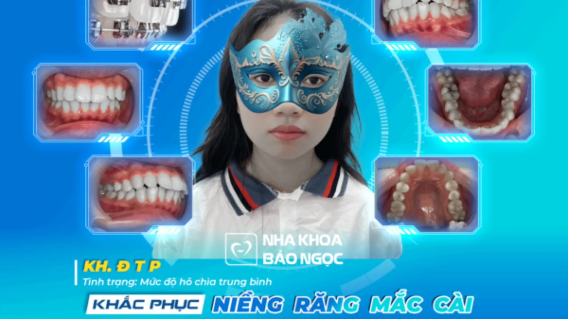 Niềng răng vui vẻ -Tạm biệt hô chìa cùng cô bé Đ.T.P 20 tuổi