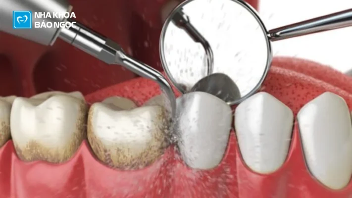 Bật mí 2 biện pháp ngăn ngừa cao răng hiệu quả mà bạn cần biết!