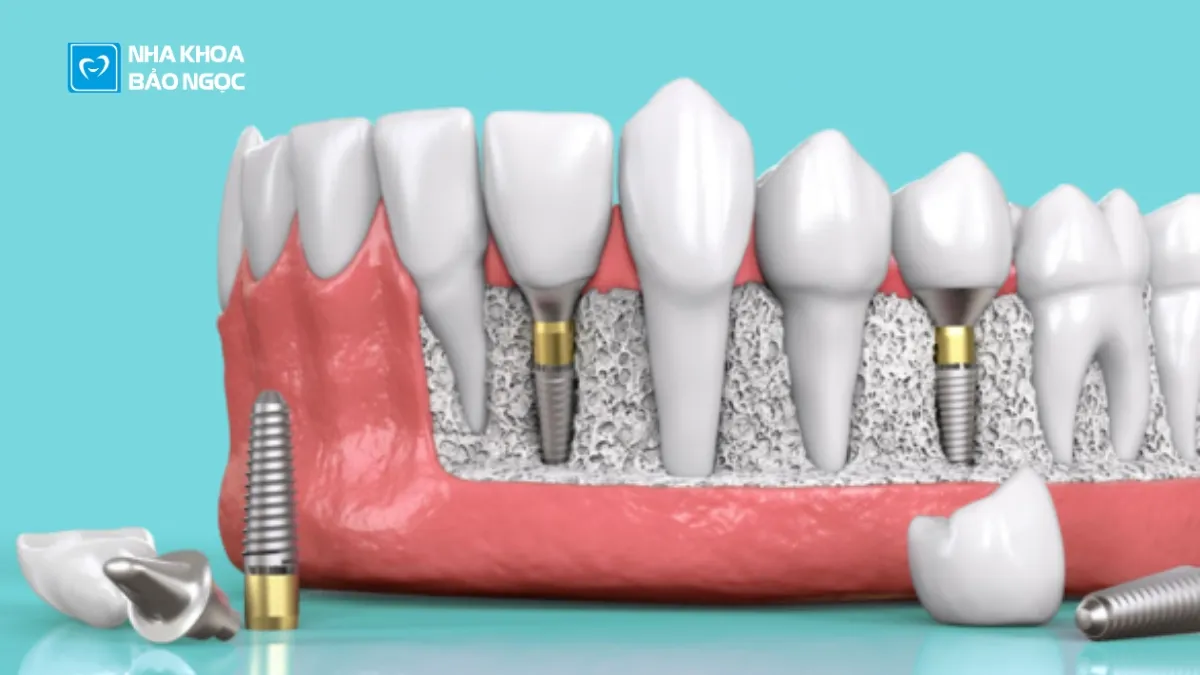Điều kiện để cấy ghép implant thành công