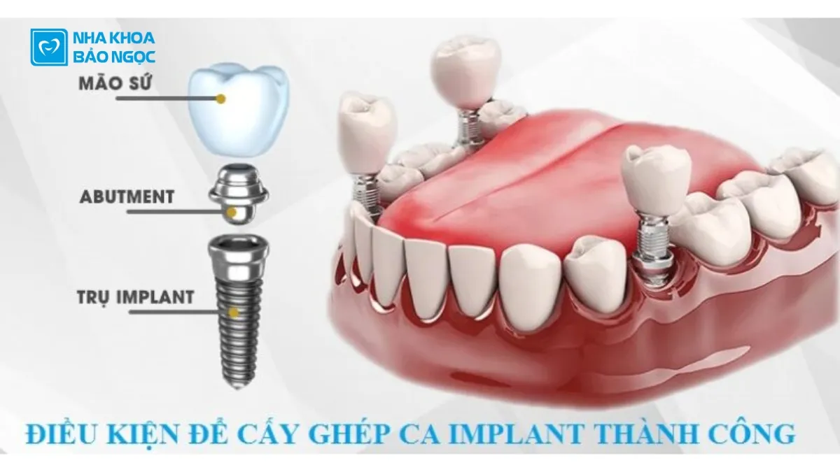 Điều kiện để cấy ghép Implant thành công