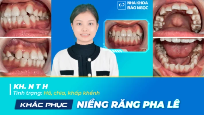 Niềng răng mắc cài pha lê cùng Thanh Huyền tìm kiếm nụ cười hoàn hảo 100%