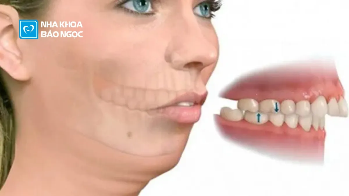 Case niềng răng có 1 không 2 của Văn Đức