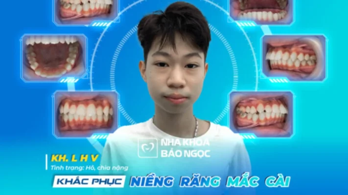 Niềng răng “tuổi vàng” khi H.V tròn 15 tuổi