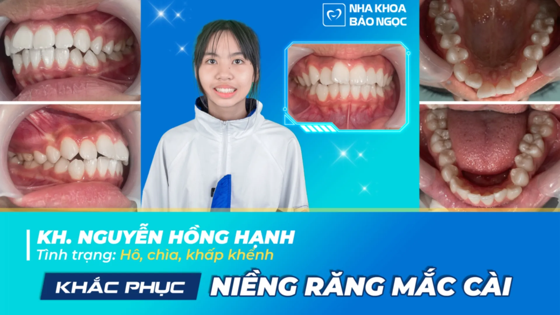 Niềng răng tiết kiệm cùng Hồng Hạnh