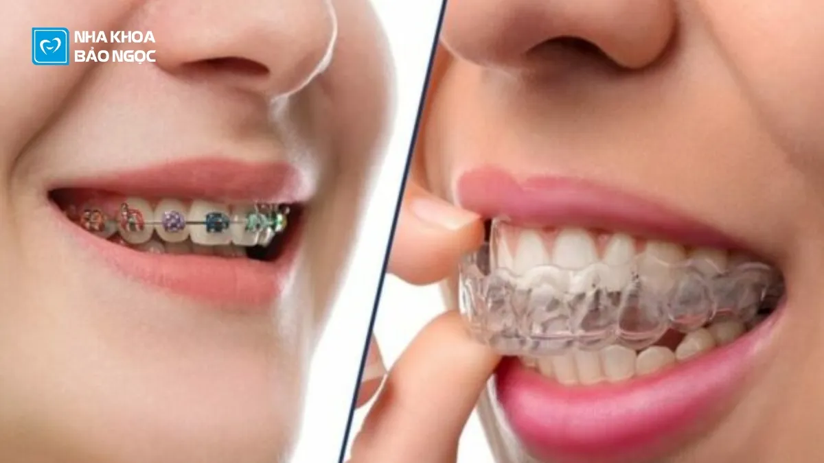 5 Giai đoạn thời gian niềng răng trong khoảng bao lâu thì có kết quả
