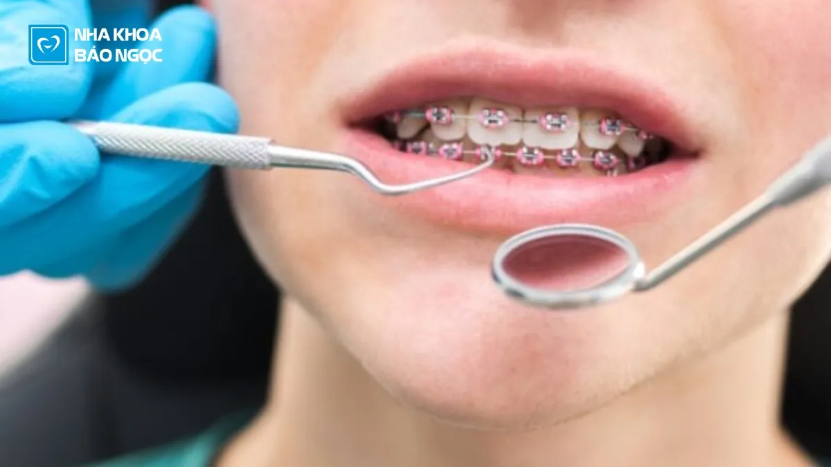 5 Giai đoạn thời gian niềng răng trong khoảng bao lâu thì có kết quả