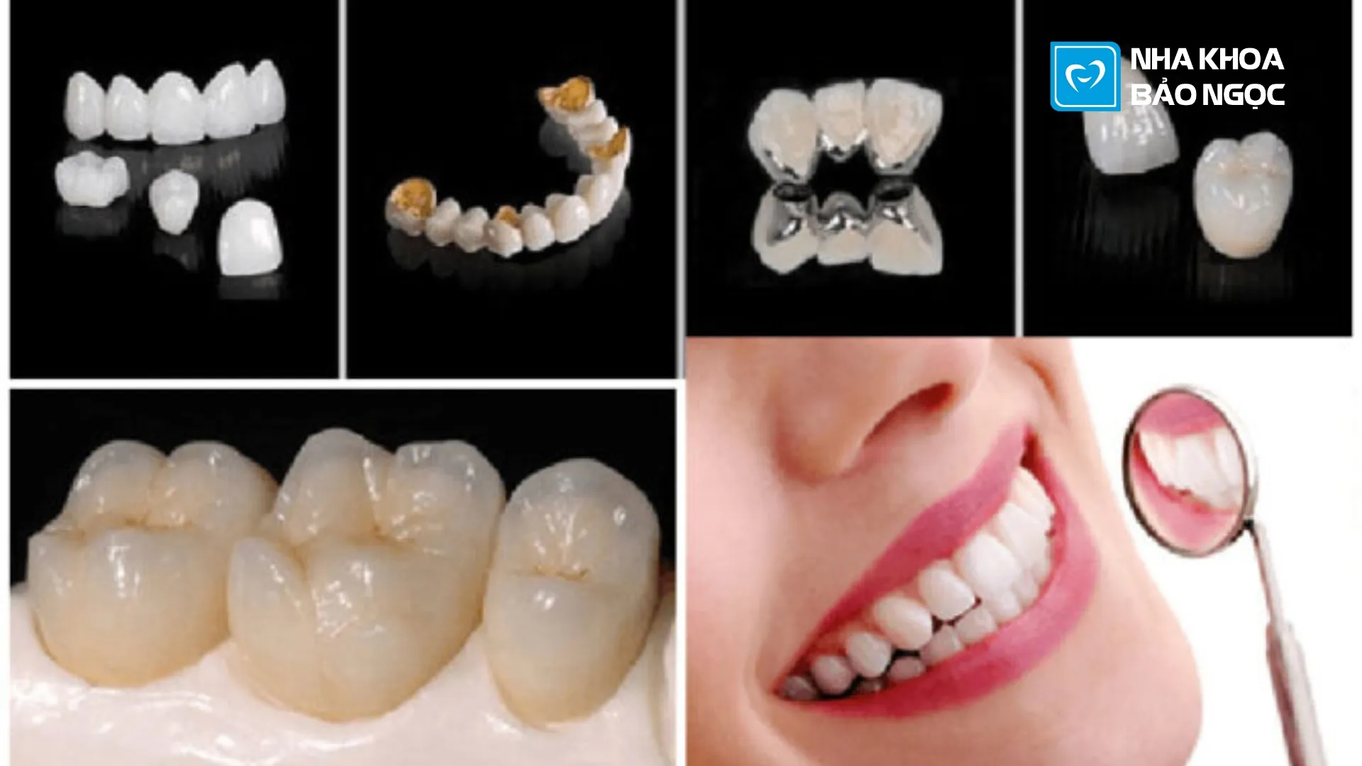 4 Kinh Nghiệm Trước Và Sau Khi Bọc Răng Sứ