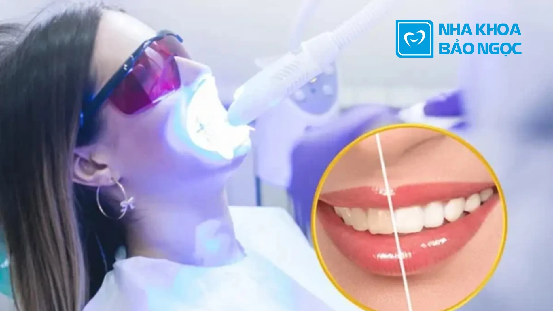Tẩy trắng răng: 4 điều cần lưu ý khi tẩy trắng răng.