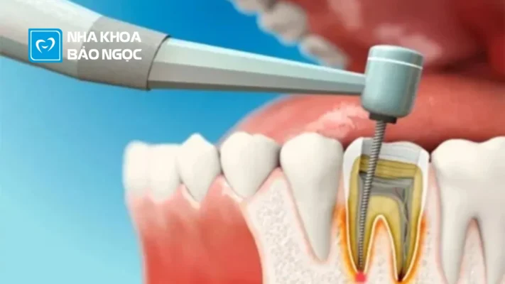 Tuỷ răng và quy trình điều trị tuỷ răng