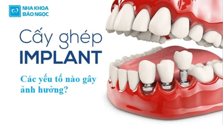 Yếu tố ảnh hưởng cấy ghép Implant