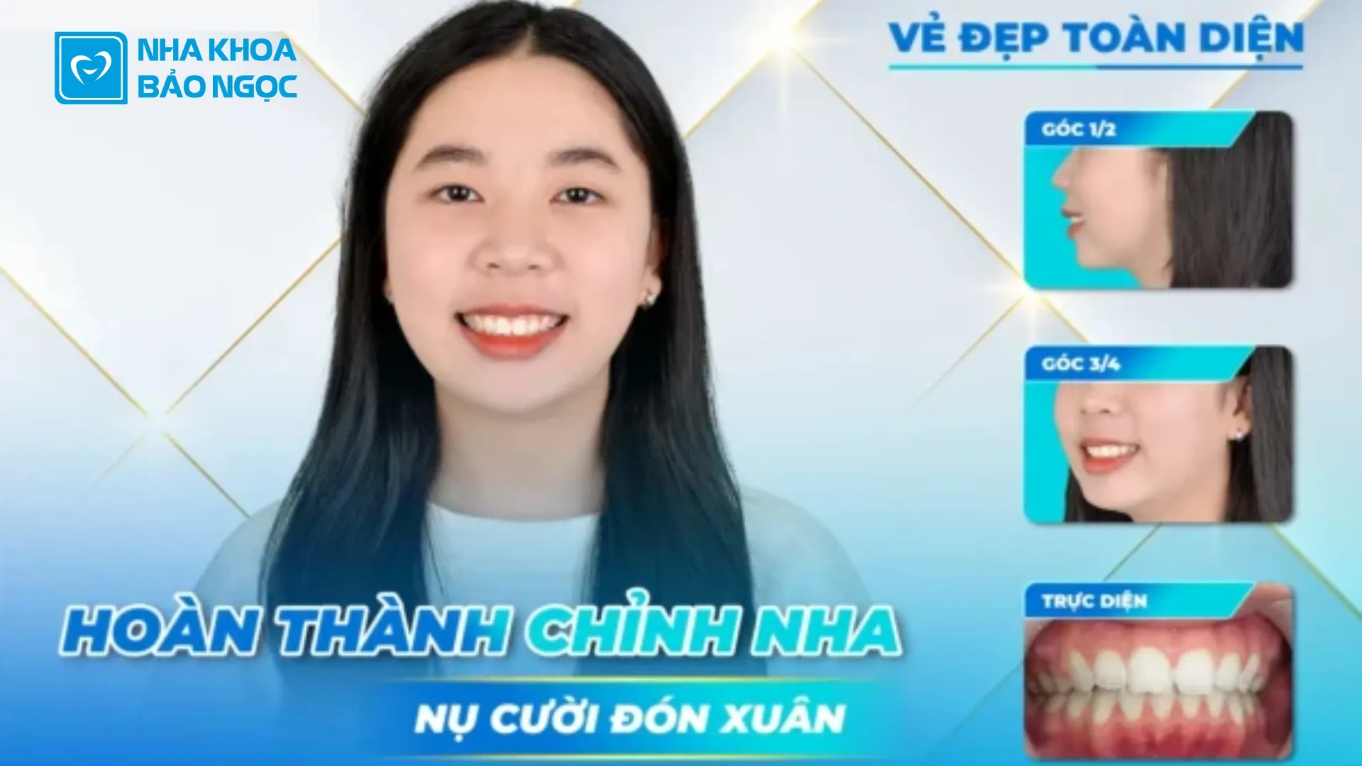Tháo niềng răng, đón nụ cười mới cùng Phương Linh 19 tuổi