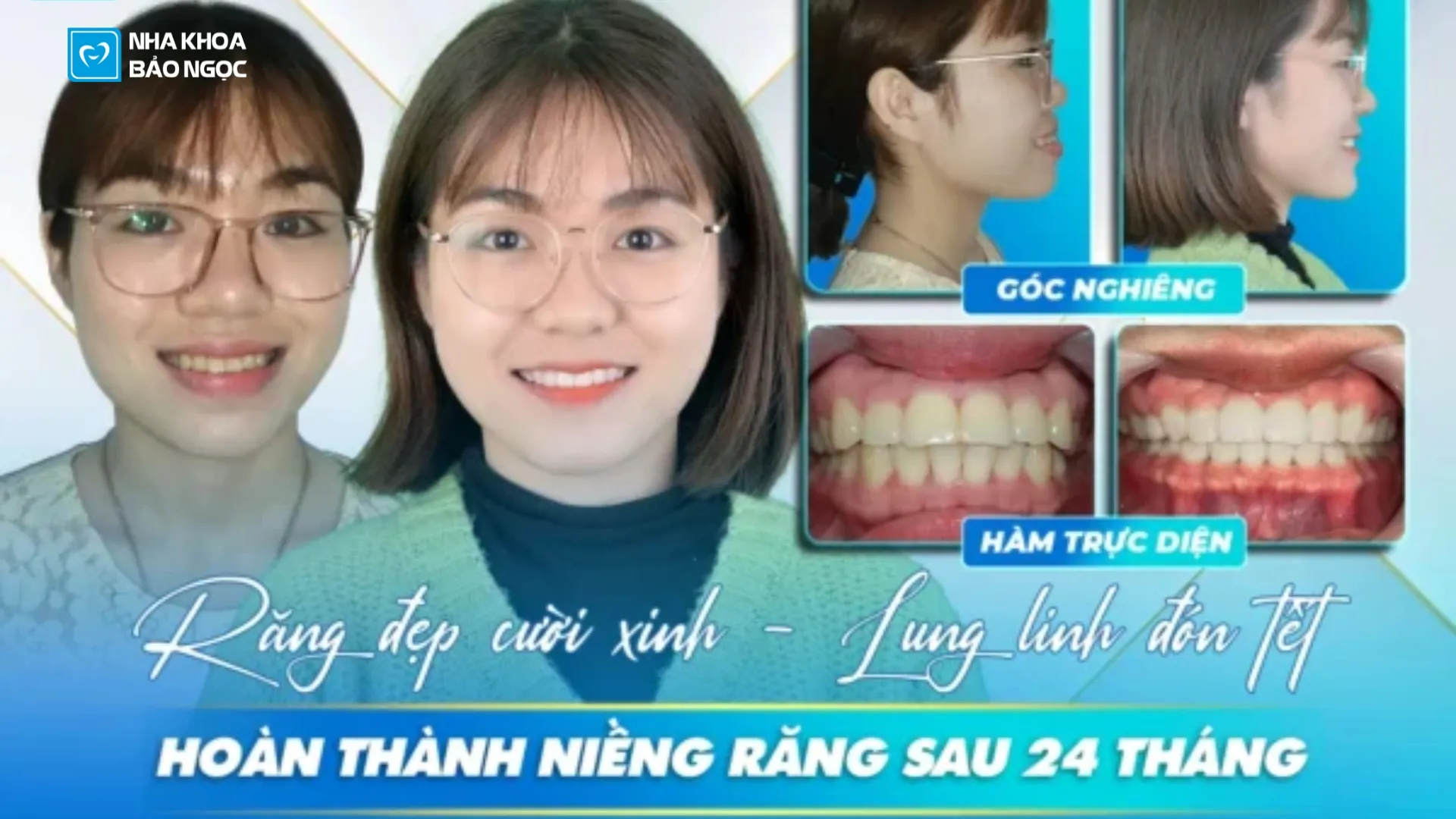 Mừng em tháo niềng răng sau 2 năm cố gắng