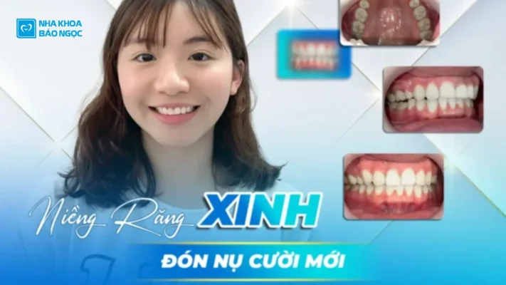 Đốn nụ cười mới sau niềng răng cùng Hoài Trang