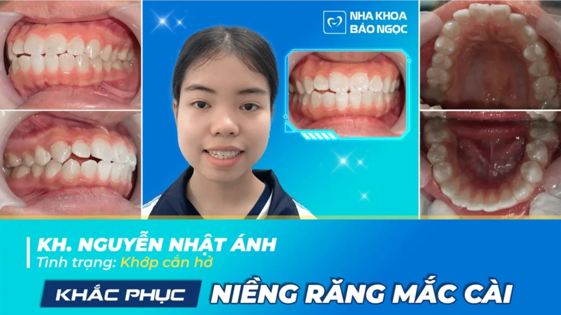 Niềng răng đón Xuân cùng Nhật Ánh 17 tuổi