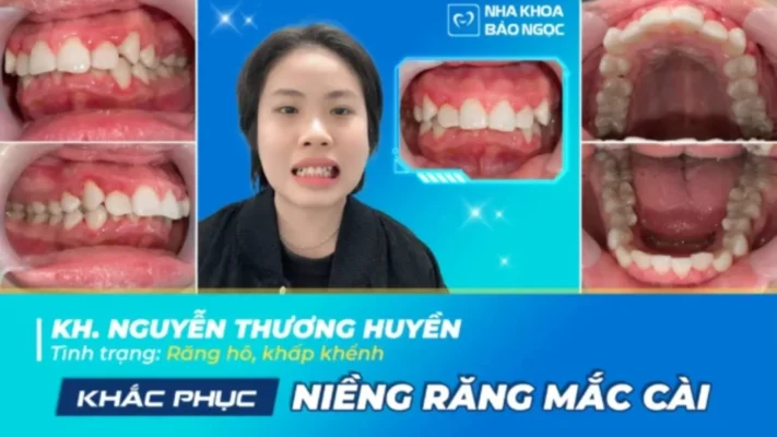 Bỏ tự ti, niềng răng tự tin cùng Thương Huyền