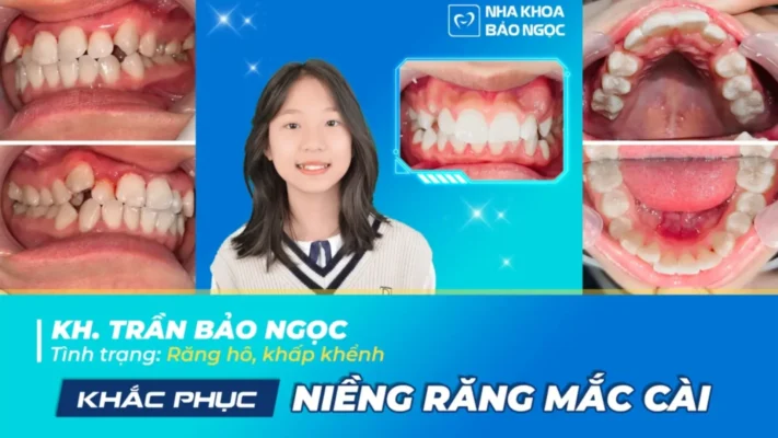 Niềng răng xinh cùng Bảo Ngọc 12 tuổi