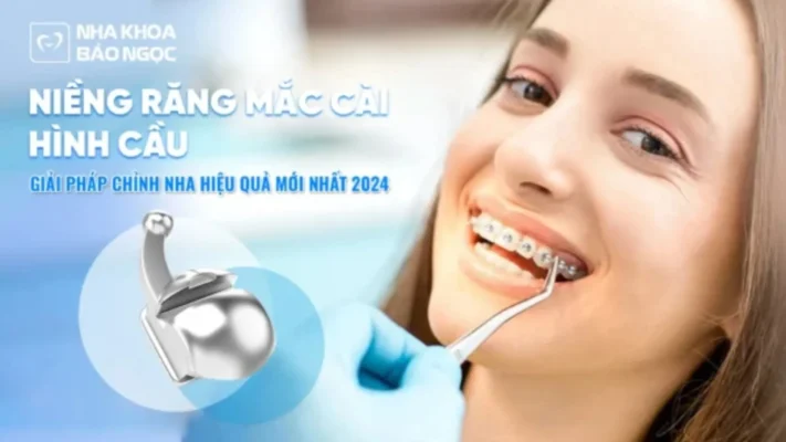Niềng răng mắc cài hình cầu – Công nghệ niềng răng không đau